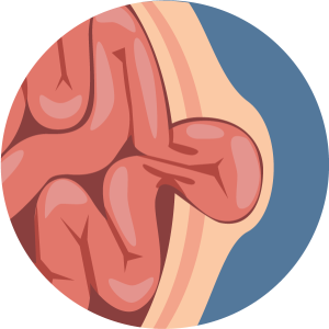 enfermedades del esofago